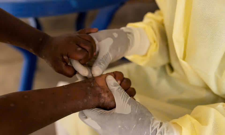 Nigeria go start Mpox vaccination from October 8 after approval